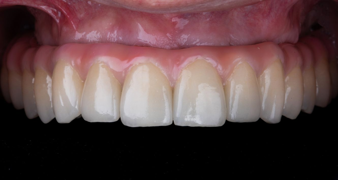 implantologie parodontologie toulouse cabinet dentaire plana