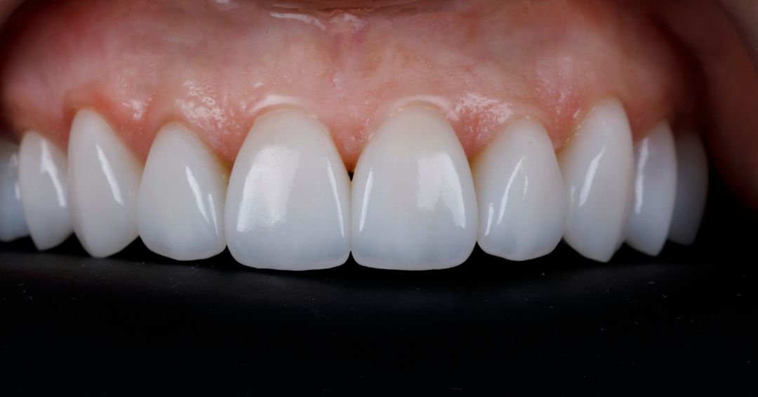 facettes dentaires, u