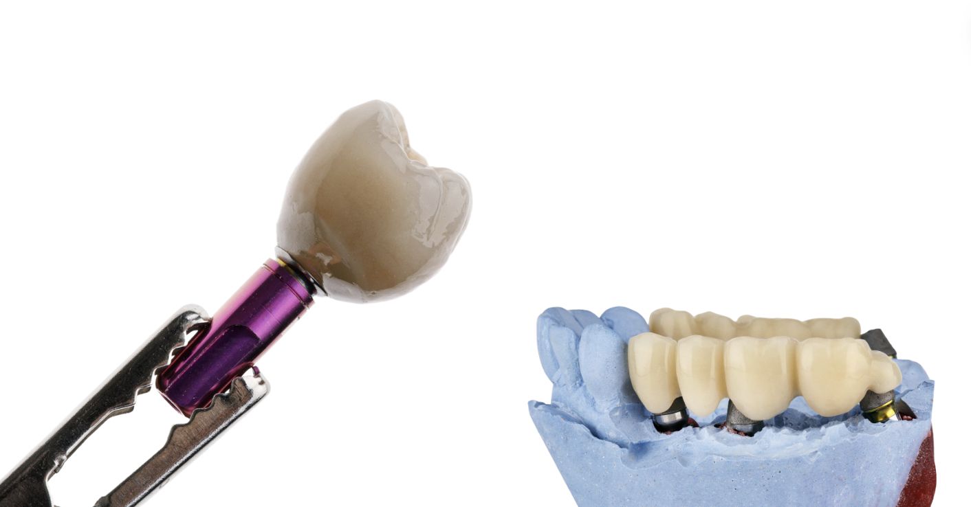 cabinet dentaire plana toulouse - parodontologie