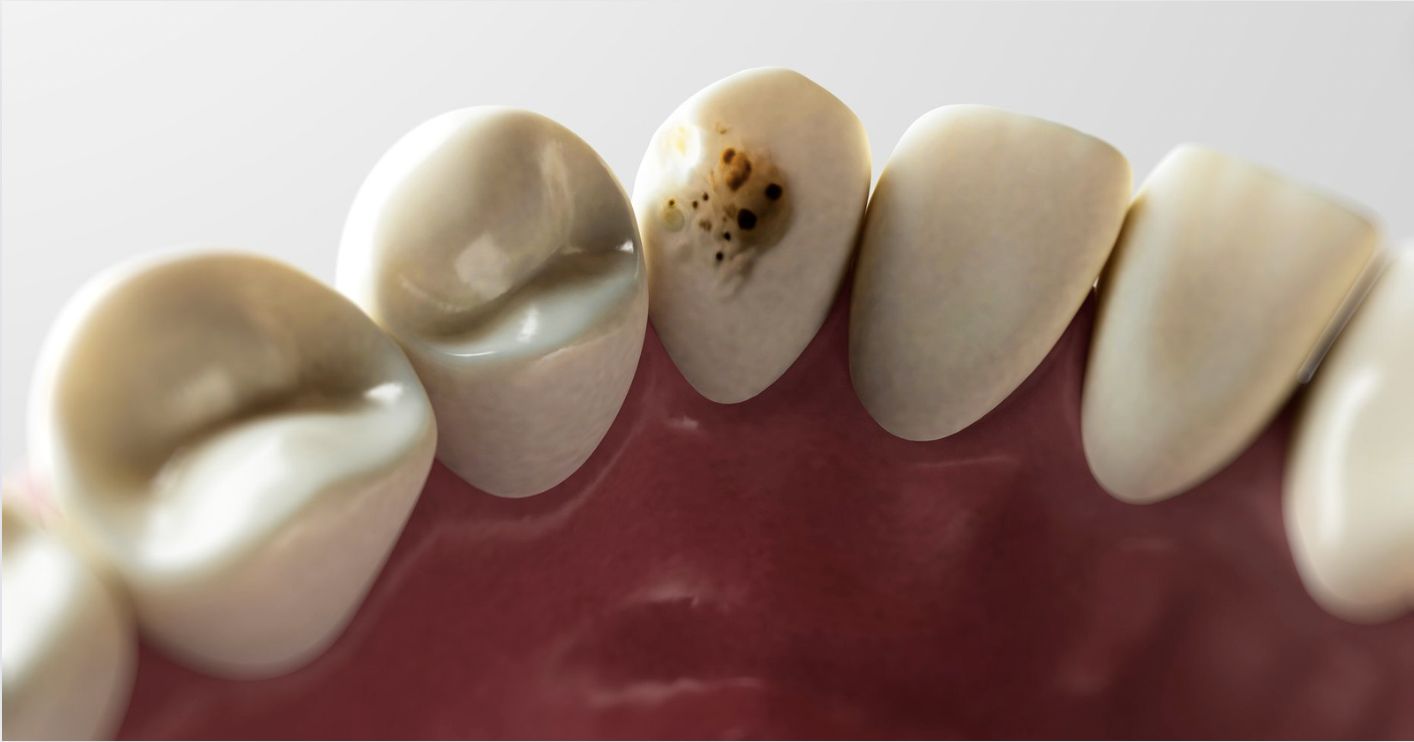 cabinet dentaire plana toulouse - parodontologie