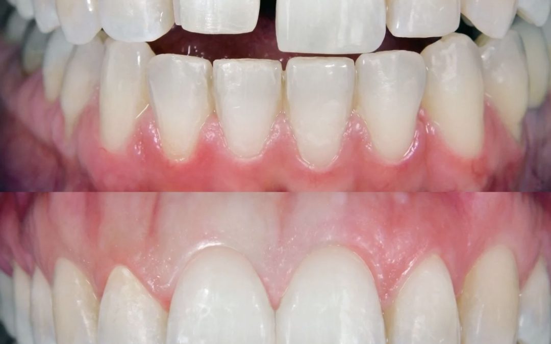 UN SOURIRE ÉCLATANT : FACETTES, BLANCHIMENT ET AUTRES OPTIONS