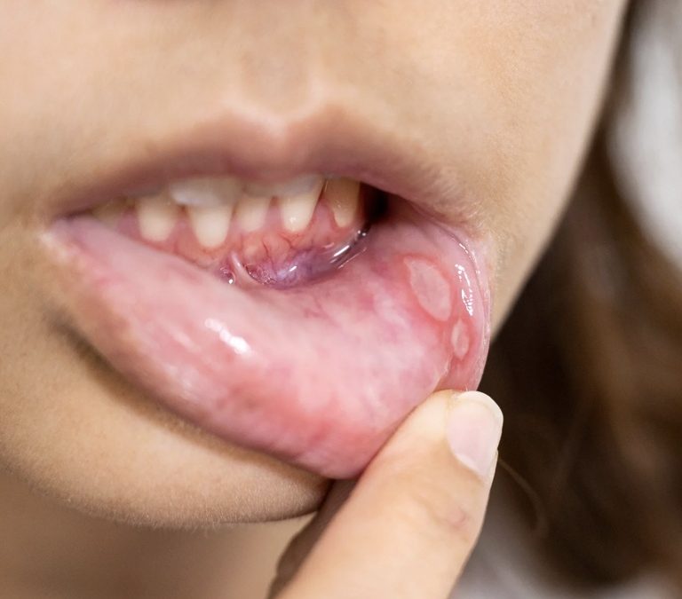 les aphtes et les ulcérations buccales