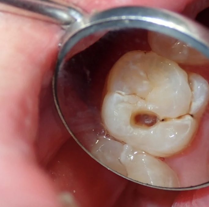 caries chez les adultes