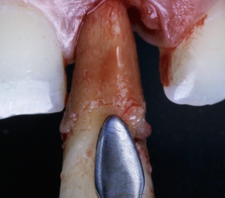 Extraction-implantation